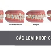 LỆCH KHỚP CẮN LÀ GÌ? KHÔNG ĐIỀU TRỊ CÓ ẢNH HƯỞNG GÌ KHÔNG?