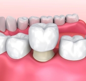 BỌC RĂNG SỨ CÓ CẦN PHẢI NHỔ RĂNG KHÔNG? CÓ CẦN LẤY TỦY KHÔNG?