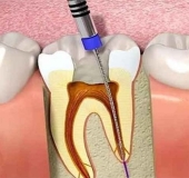 ĐIỀU TRỊ RĂNG SÂU VÀO TỦY CÓ GIỮ RĂNG ĐƯỢC KHÔNG? DẤU HIỆU NHẬN BIẾT?