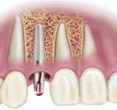 DẤU HIỆU NHẬN BIẾT TRỤ IMPLANT BỊ ĐÀO THẢI LÀ GÌ? CÁCH XỬ LÝ NHƯ THẾ NÀO?