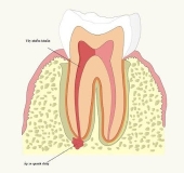 PHẨU THUẬT CẮT CHÓP VÀ NHỮNG ĐIỀU CẦN BIẾT?