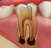 CHĂM SÓC, BẢO VỆ RĂNG SAU KHI CHỮA TỦY NHƯ THẾ NÀO?