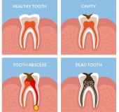 VIÊM TỦY RĂNG LÀ GÌ? CÓ NGUY HIỂM VÀ TRIỆU CHỨNG RA SAO?